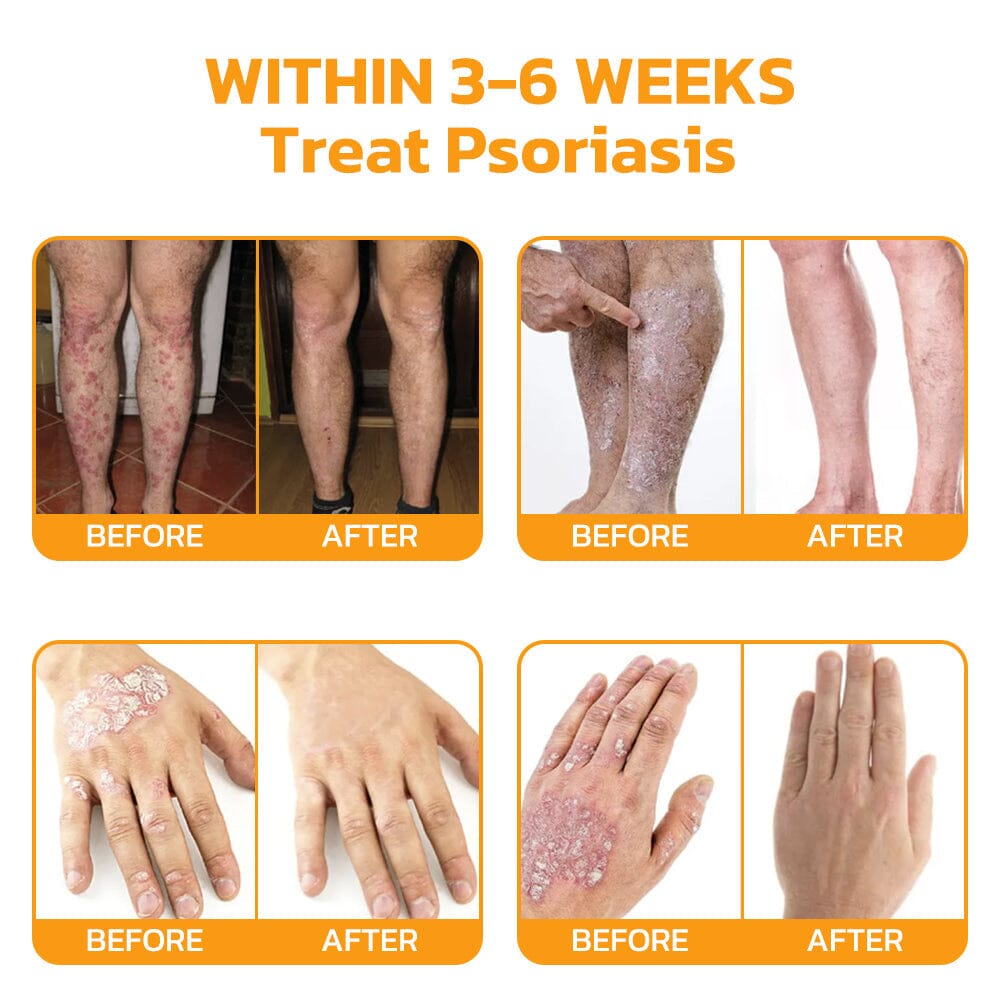 Therapeutic Products Directorate (TPD)✅ Furzero™ Bee Venom Skincare Treatment Pads (⚕️AAD Recommended)